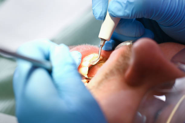 Best Emergency Wisdom Teeth Removal in Lansdowne, MD